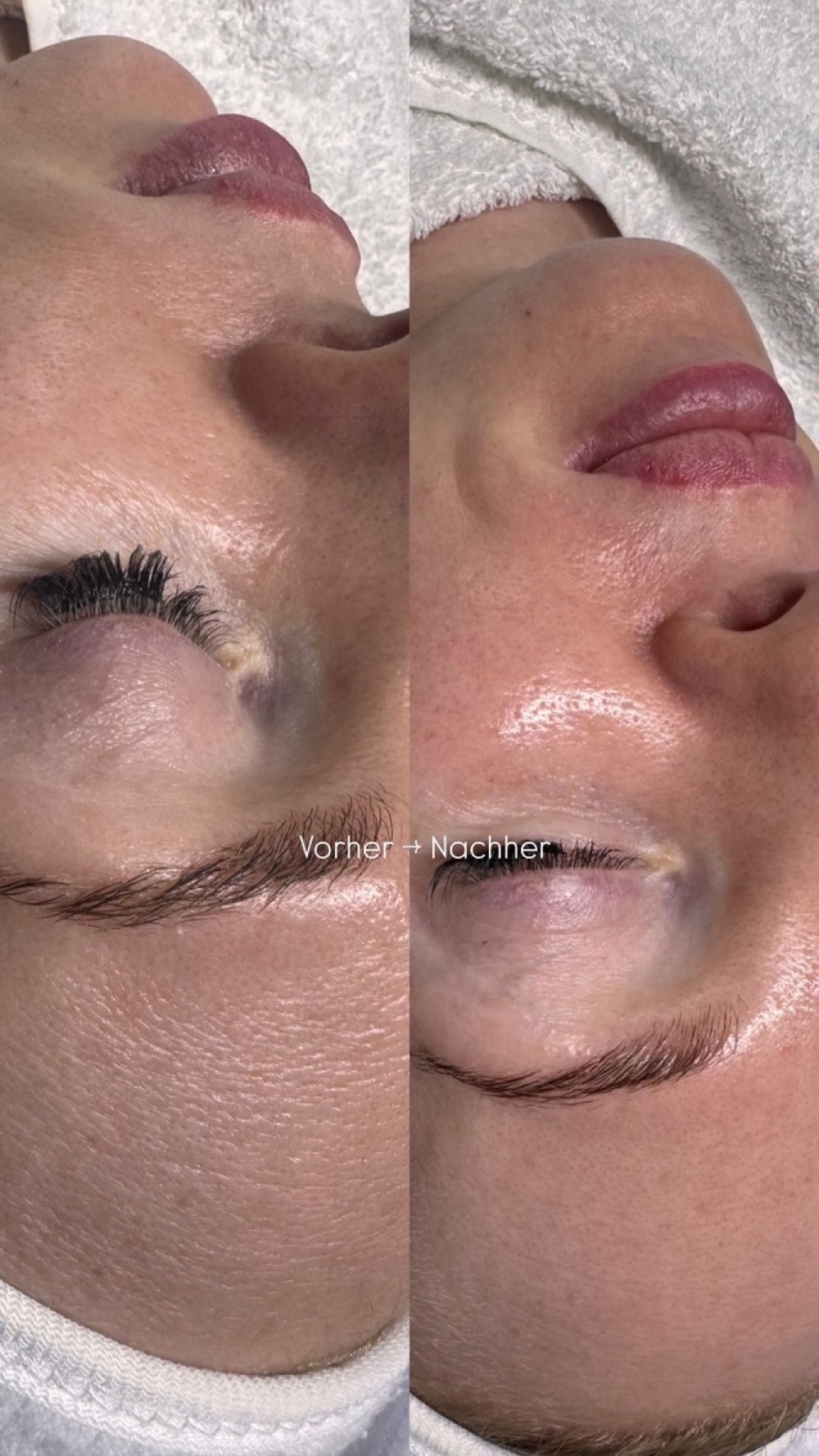 Vorher-Nachher-Vergleich einer Fruchtsäurebehandlung bei Beauty E&C Skin Expert