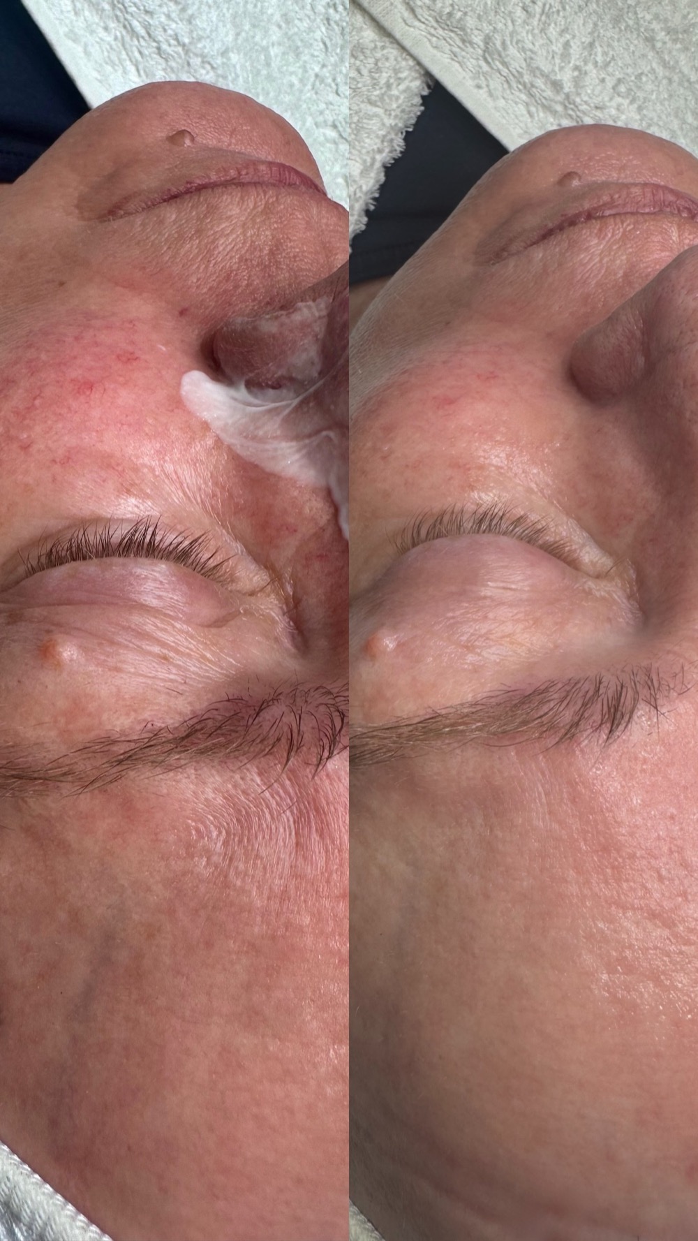 Vorher-Nachher-Vergleich einer Wirkstoffbehandlung bei Beauty E&C Skin Expert
